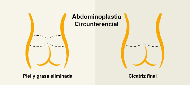 Abdominoplastia Circunferencial